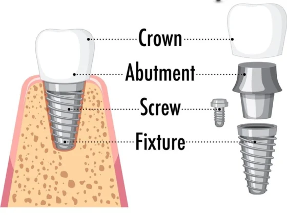 Types & Procedures of Dental Implants