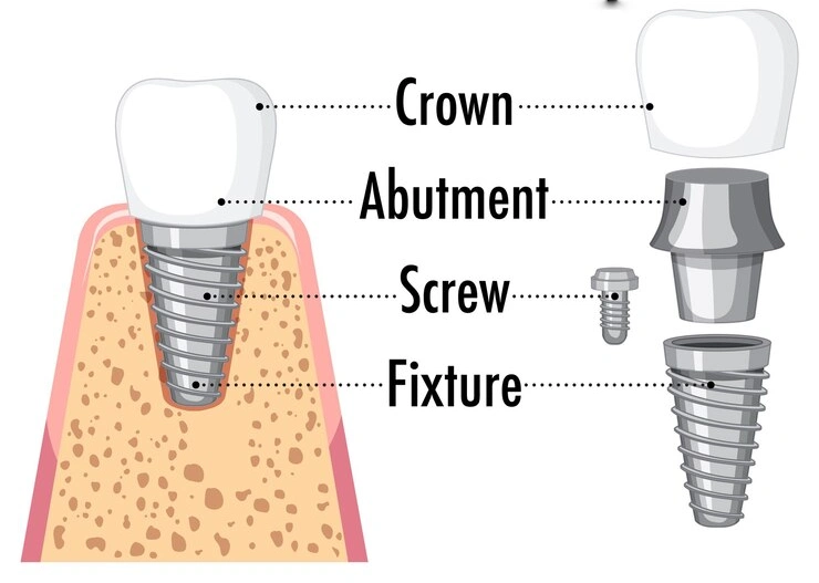 Dental Implants in wakad