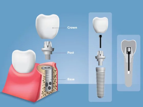 What is Dental Implant Failure?