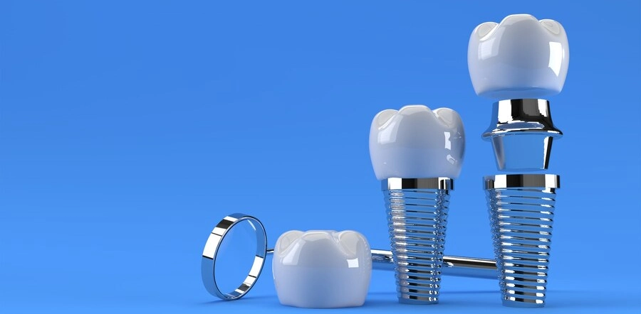 Dental Implants: A Lasting Solution for Missing Teeth in Wakad